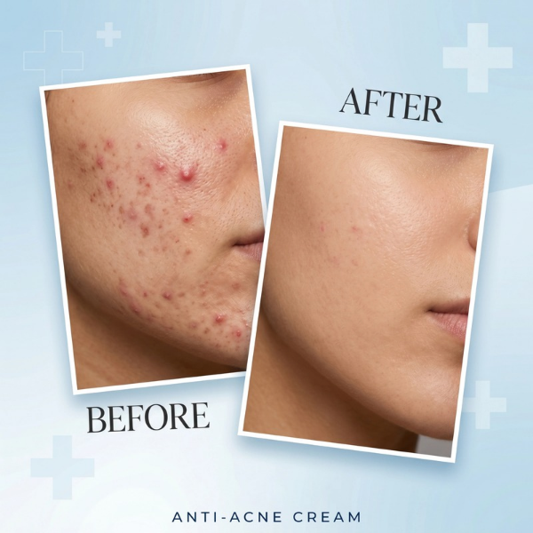 Dr. Romia Anti Acne Face - TabletStore.Pk