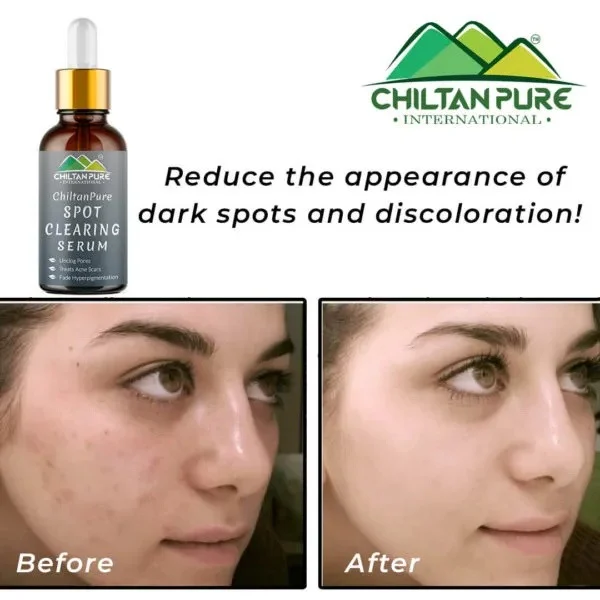 ChiltanPure Spot Clearing Serum - TabletStore.Pk